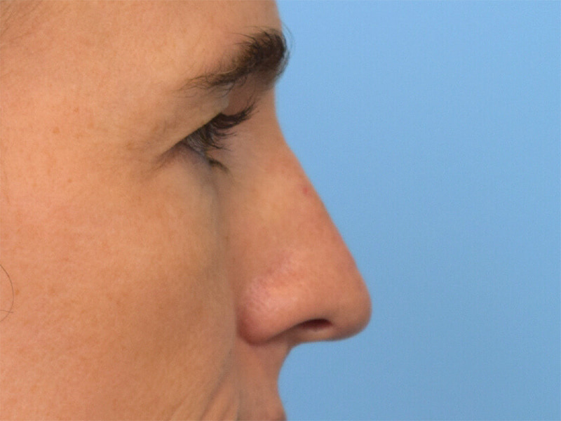 Rhinoplasty Before & After Image