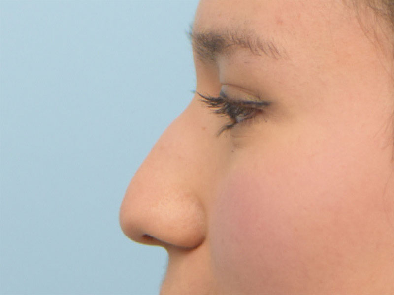 Rhinoplasty Before & After Image