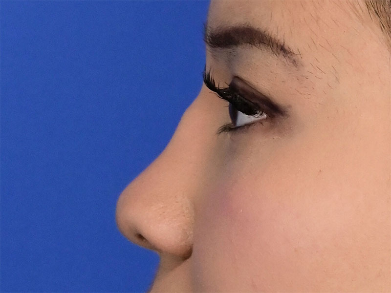 Rhinoplasty Before & After Image