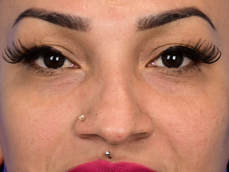 Rhinoplasty Before & After Image
