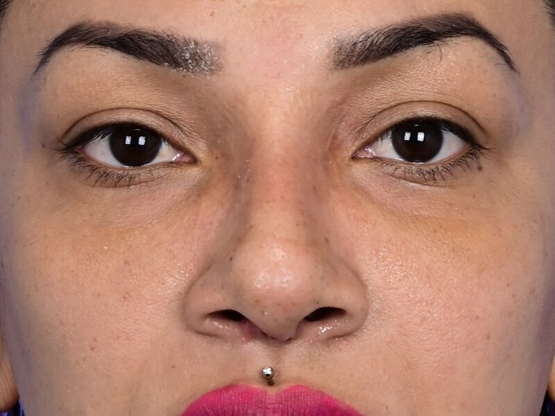 Rhinoplasty Before & After Image