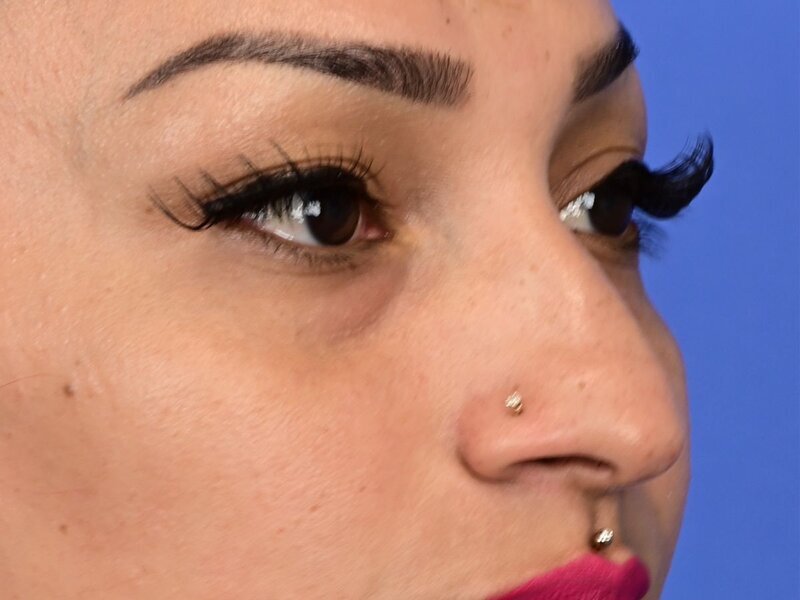 Rhinoplasty Before & After Image
