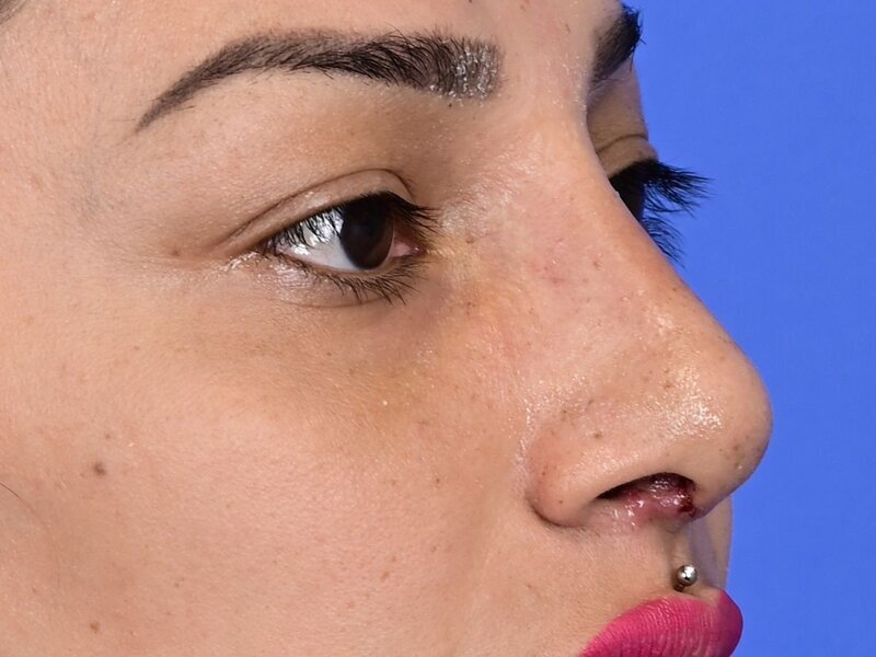 Rhinoplasty Before & After Image