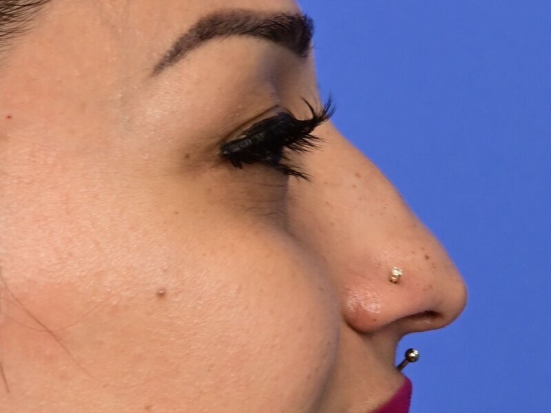 Rhinoplasty Before & After Image