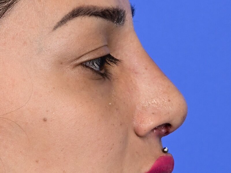 Rhinoplasty Before & After Image