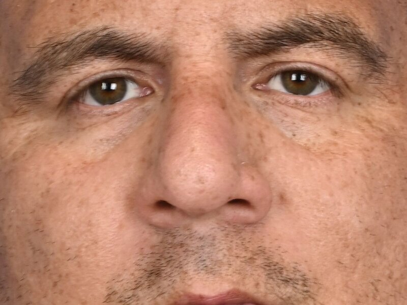 Rhinoplasty Before & After Image