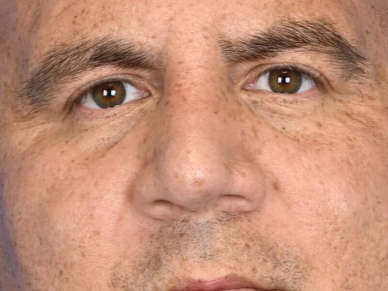 Rhinoplasty Before & After Image
