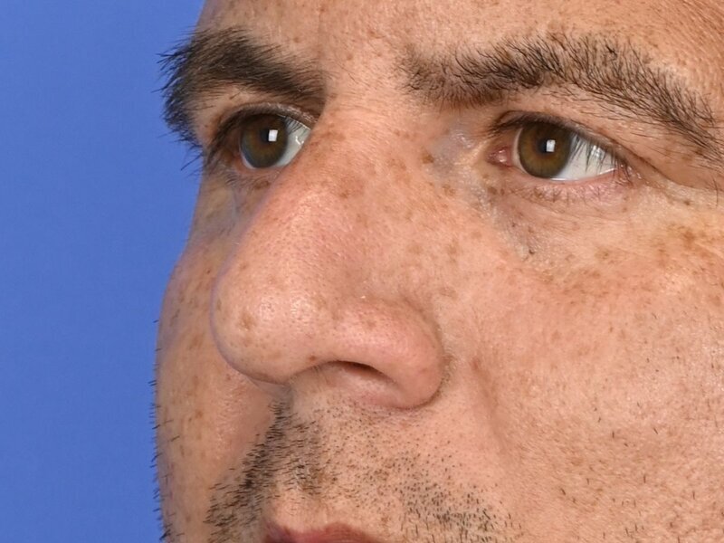 Rhinoplasty Before & After Image