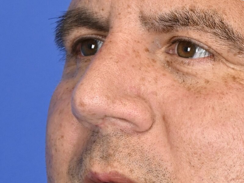 Rhinoplasty Before & After Image