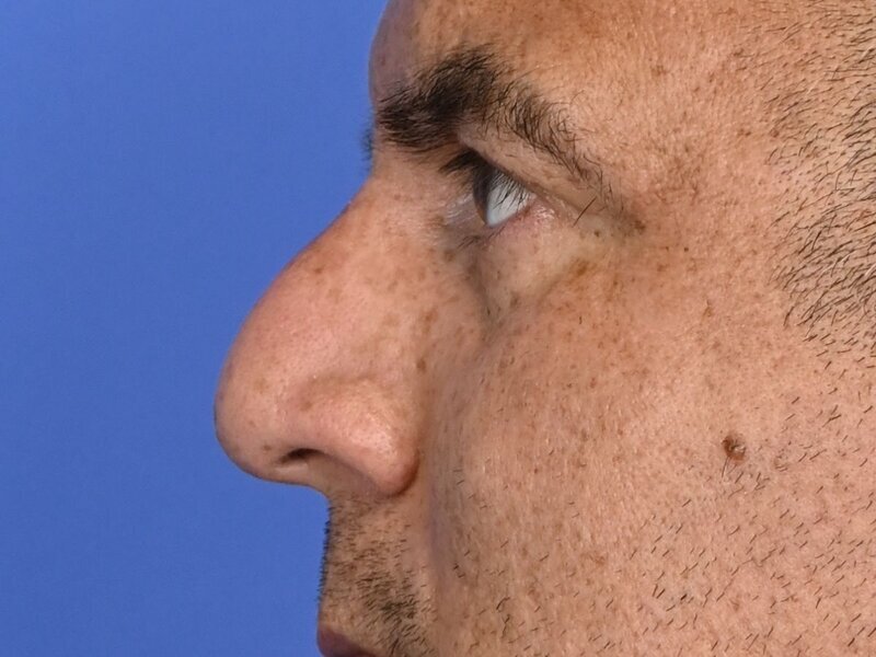 Rhinoplasty Before & After Image