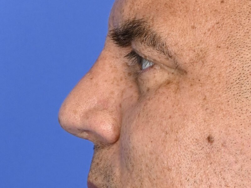 Rhinoplasty Before & After Image