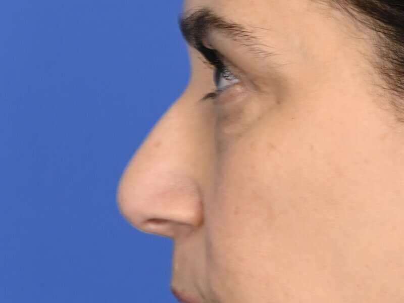 Rhinoplasty Before & After Image