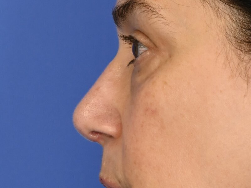Rhinoplasty Before & After Image