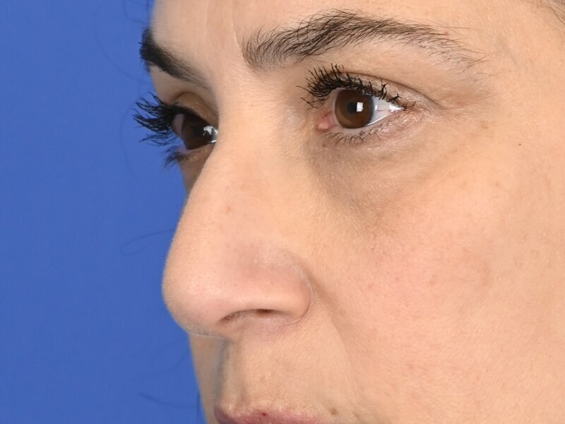 Rhinoplasty Before & After Image