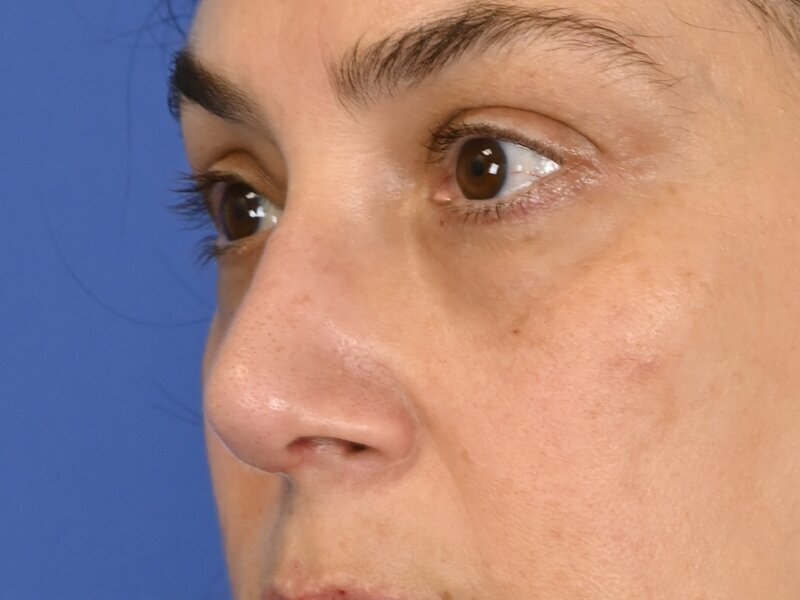 Rhinoplasty Before & After Image