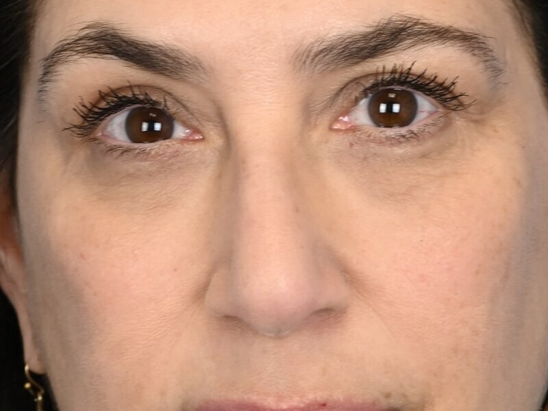 Rhinoplasty Before & After Image