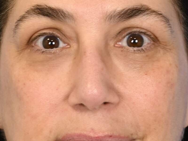 Rhinoplasty Before & After Image