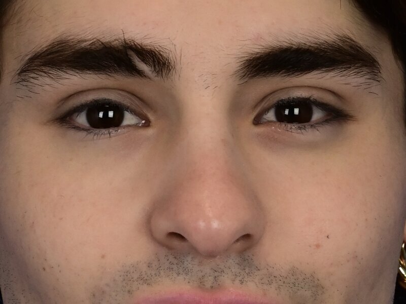 Rhinoplasty Before & After Image