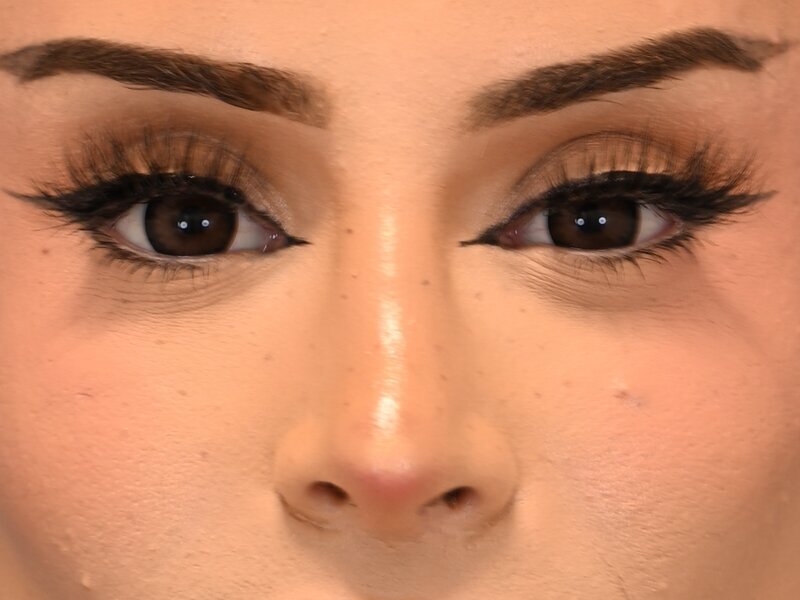 Rhinoplasty Before & After Image