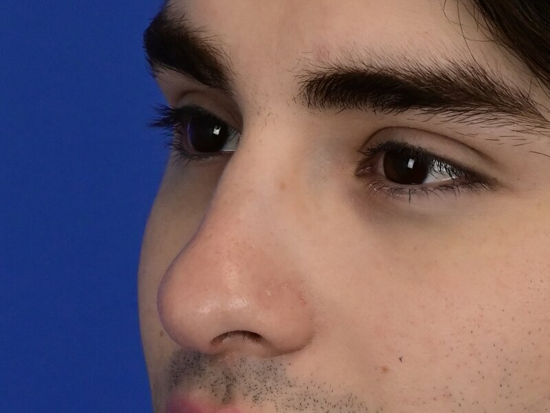 Rhinoplasty Before & After Image
