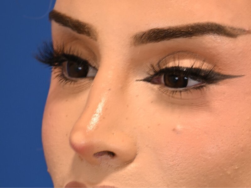 Rhinoplasty Before & After Image