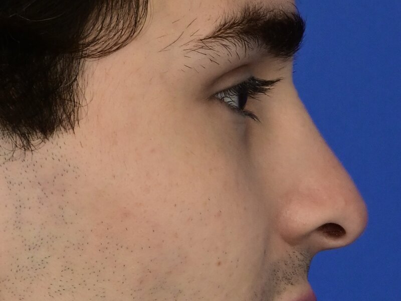 Rhinoplasty Before & After Image