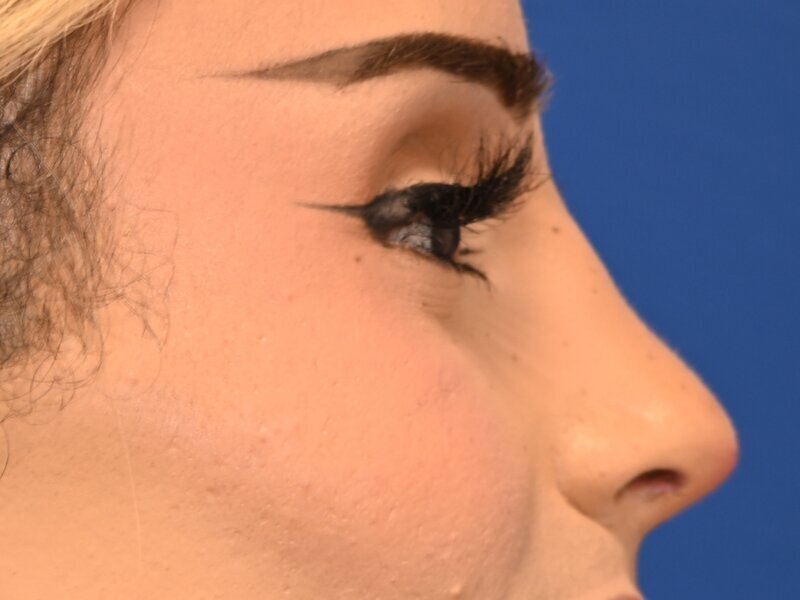 Rhinoplasty Before & After Image