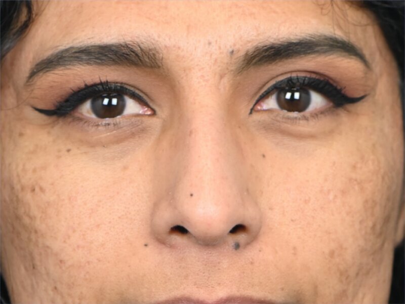 Rhinoplasty Before & After Image