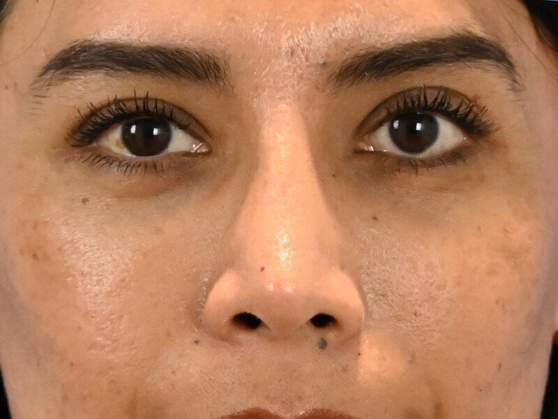 Rhinoplasty Before & After Image