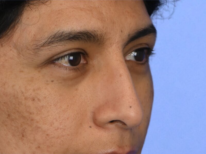Rhinoplasty Before & After Image