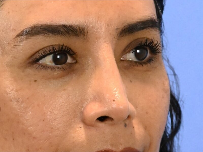 Rhinoplasty Before & After Image