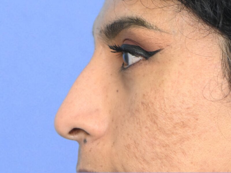 Rhinoplasty Before & After Image