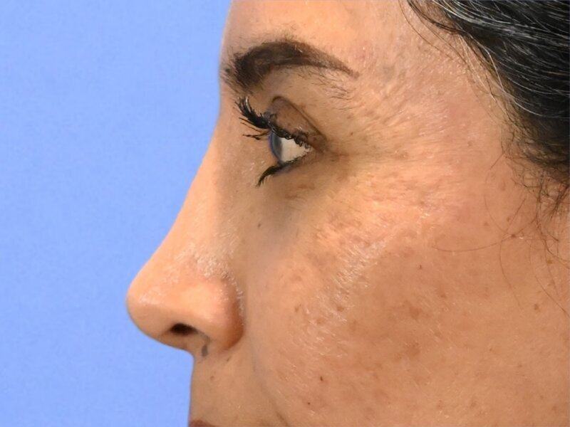 Rhinoplasty Before & After Image