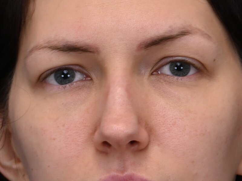 Rhinoplasty Before & After Image