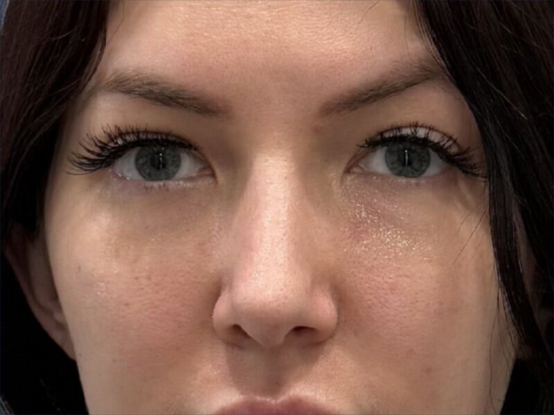 Rhinoplasty Before & After Image