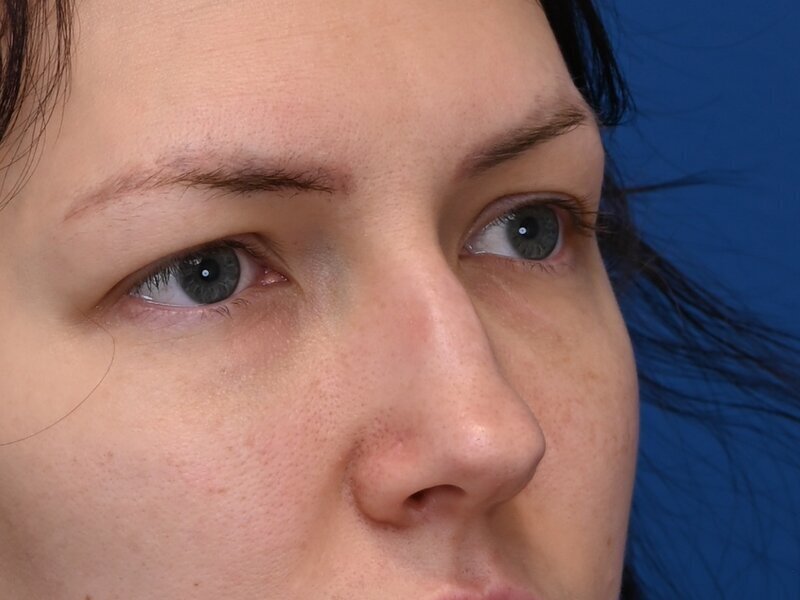 Rhinoplasty Before & After Image