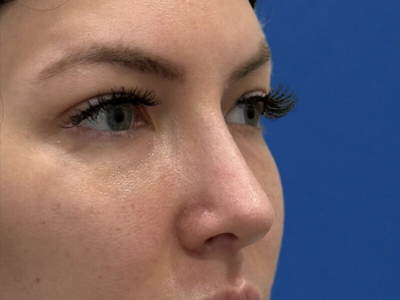 Rhinoplasty Before & After Image