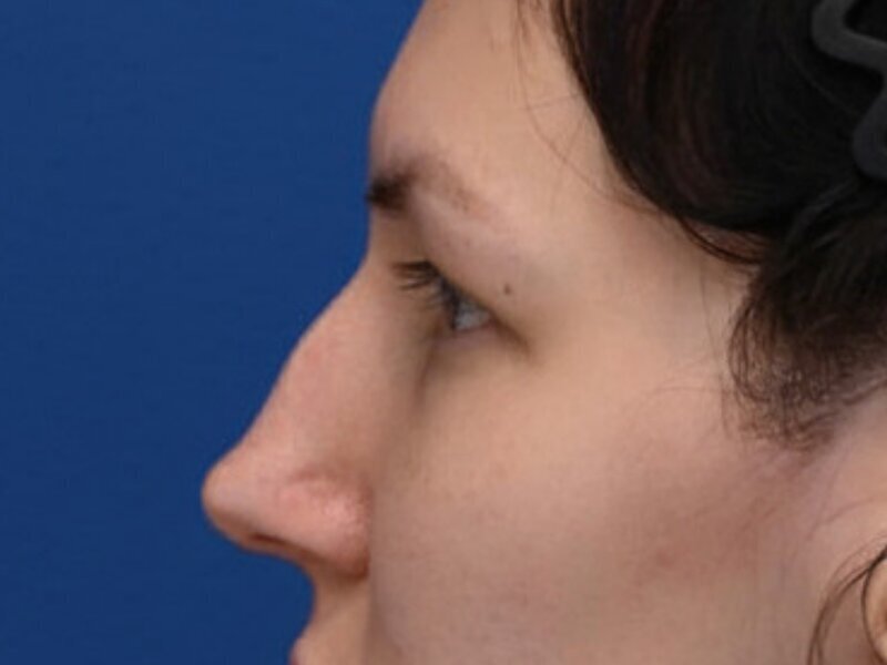 Rhinoplasty Before & After Image