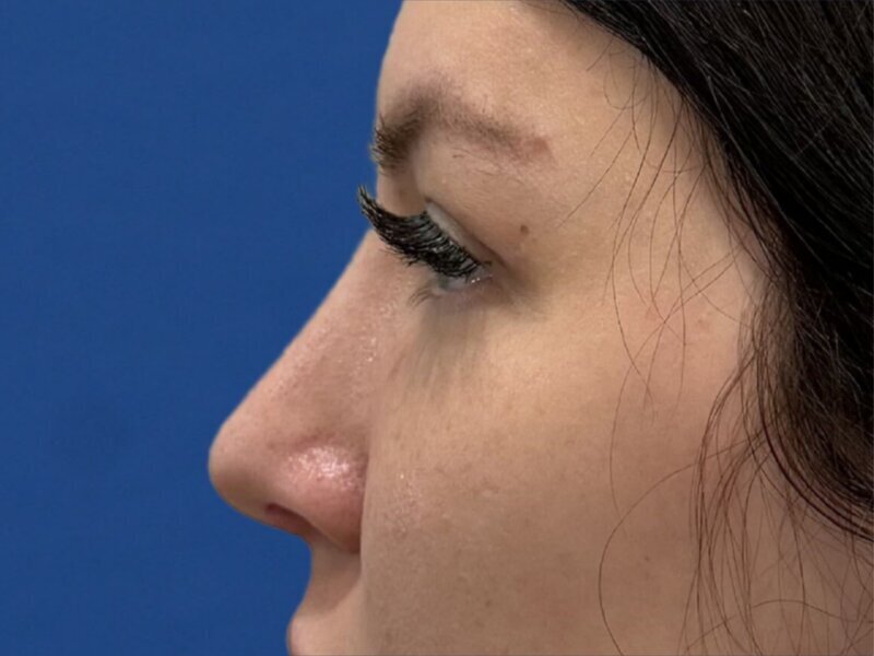 Rhinoplasty Before & After Image