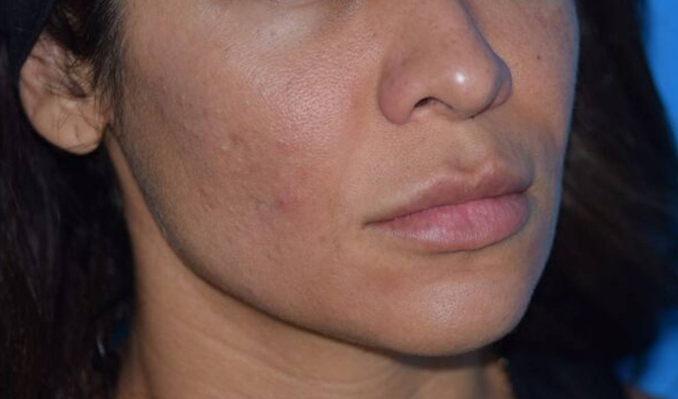 Melange Power Peel Before & After Image