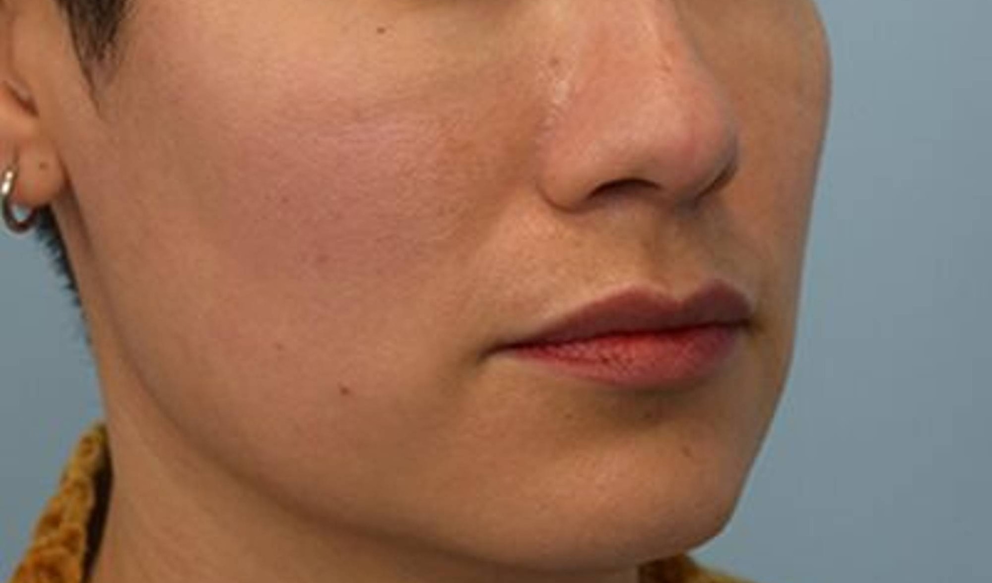 Melange Power Peel Before & After Image