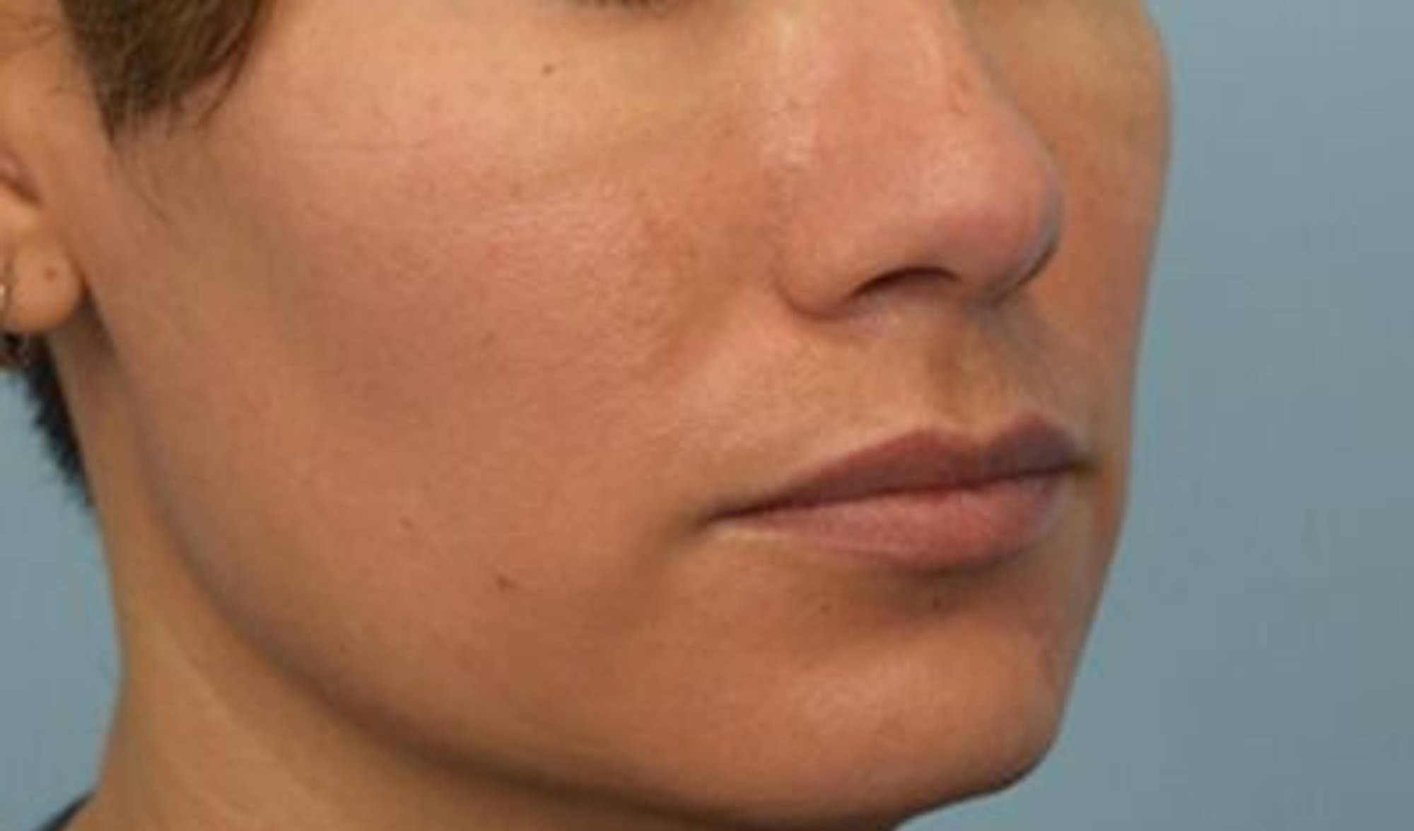 Melange Power Peel Before & After Image