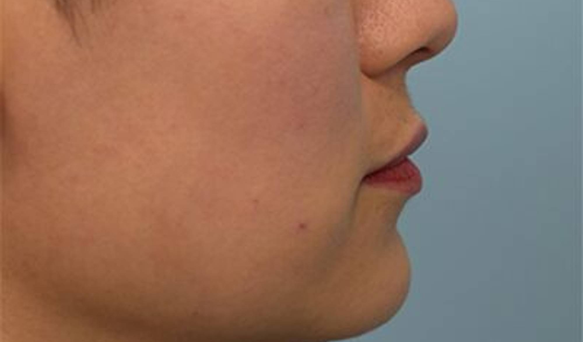 Melange Power Peel Before & After Image