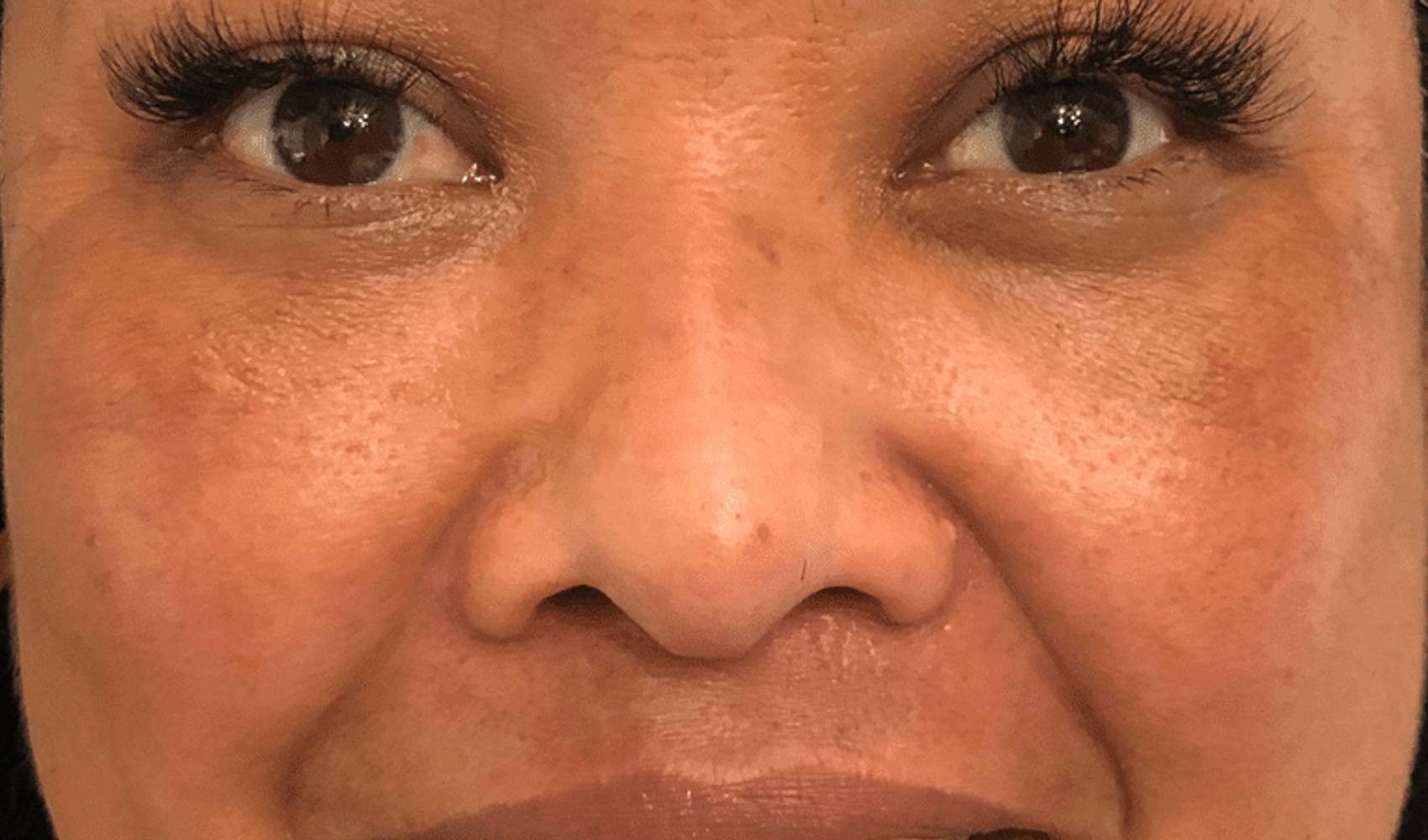 Melange Power Peel Before & After Image