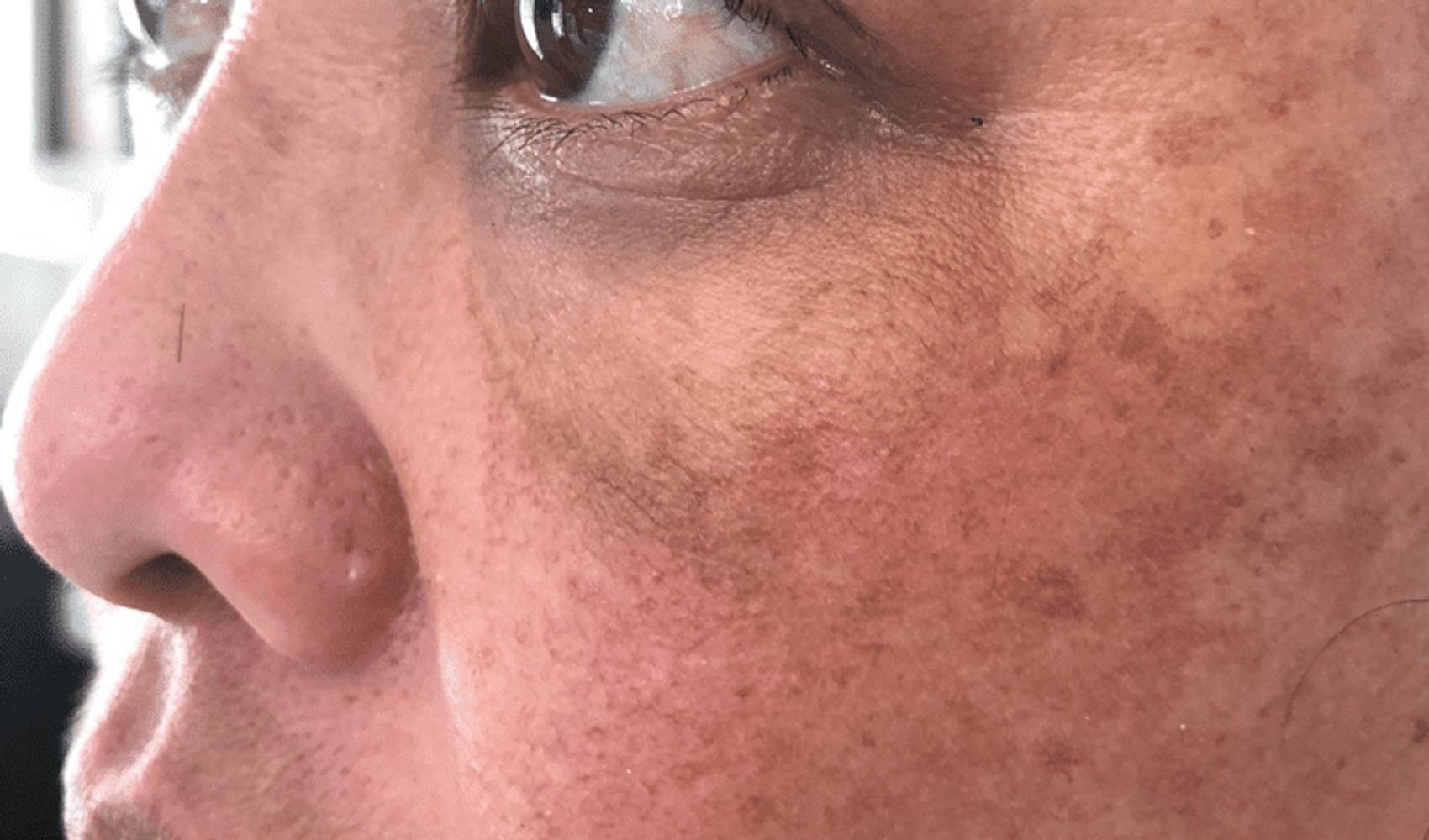 Melange Power Peel Before & After Image