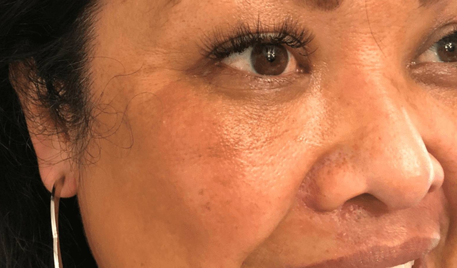 Melange Power Peel Before & After Image