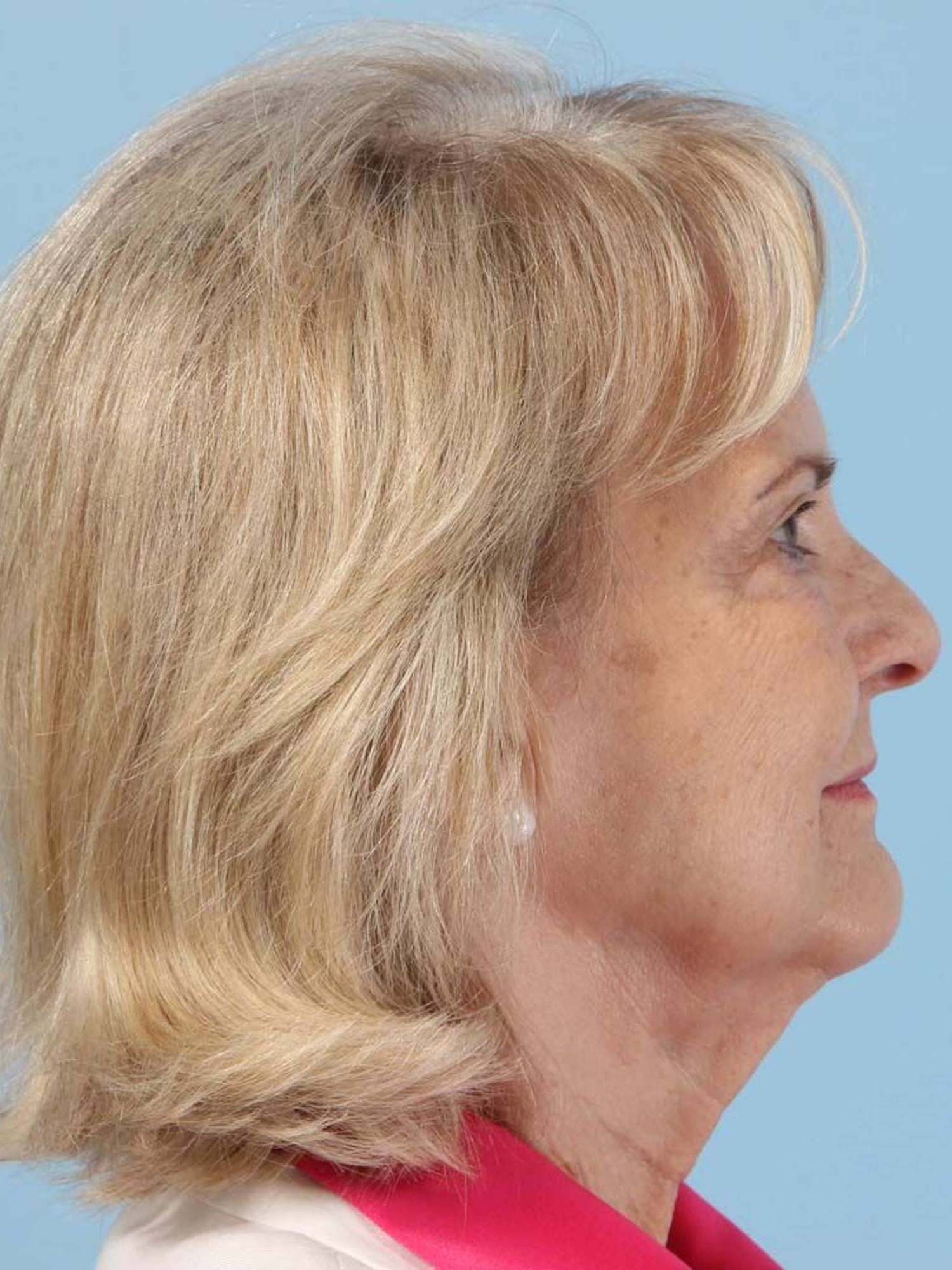 Renuvion Skin Resurfacing Before & After Image