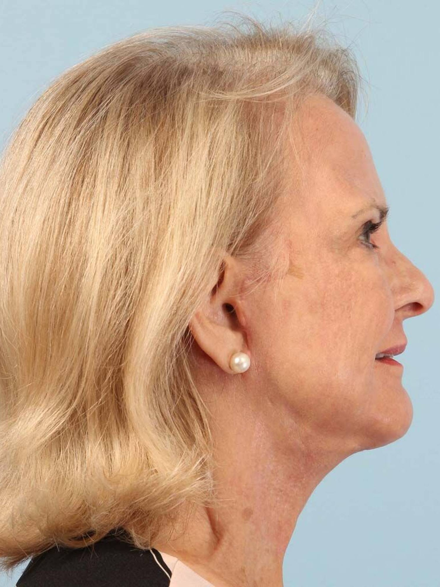 Renuvion Skin Resurfacing Before & After Image