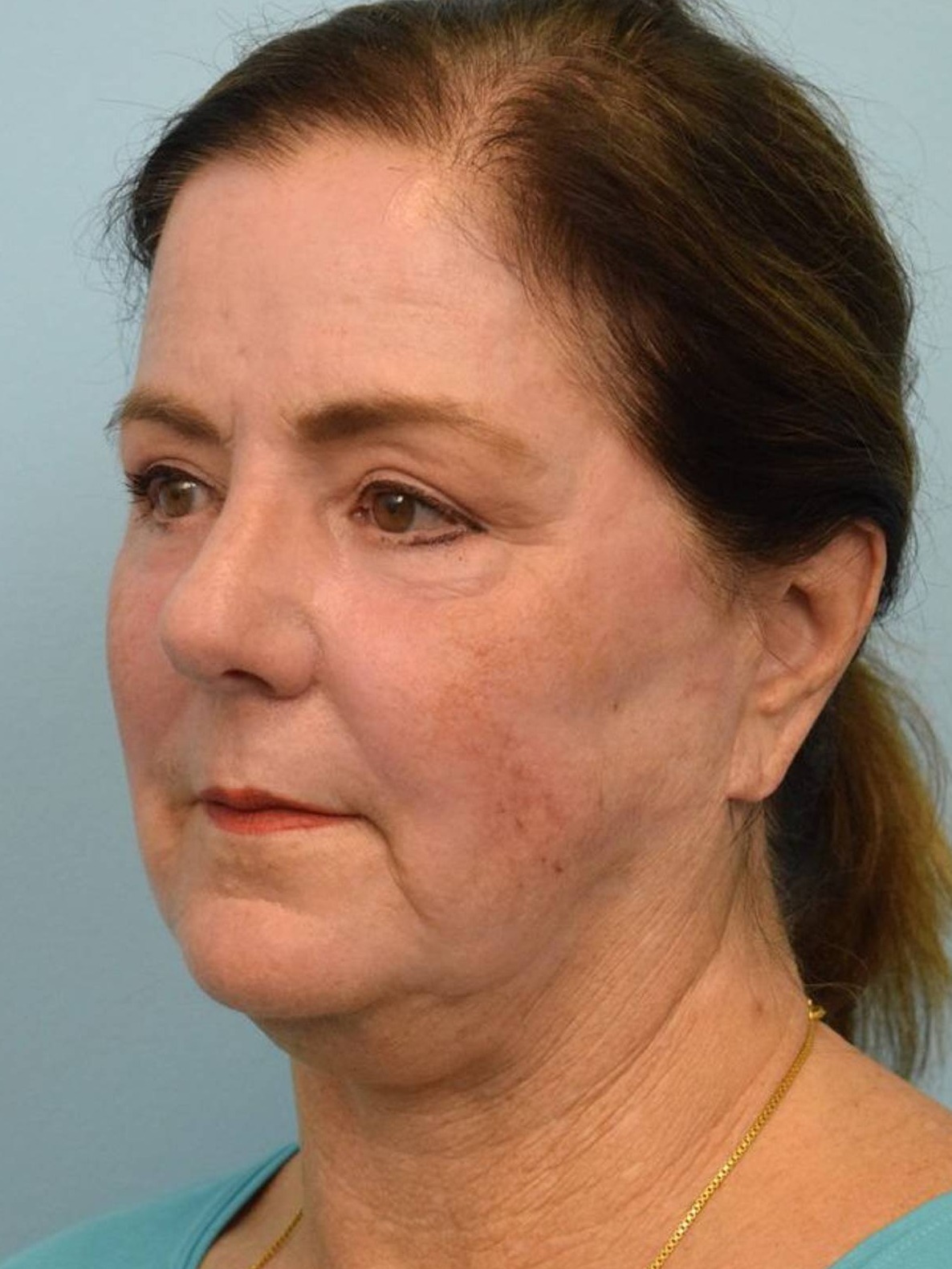 Renuvion Skin Resurfacing Before & After Image