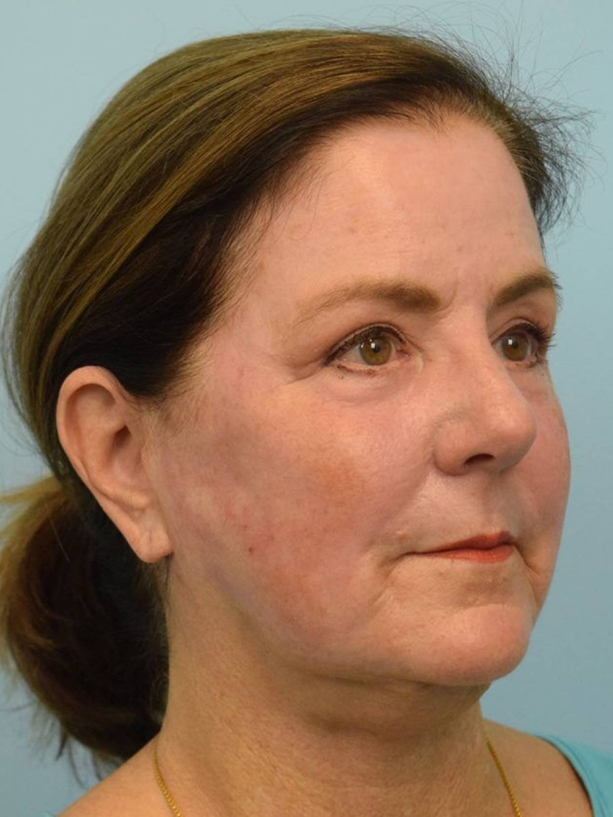 Renuvion Skin Resurfacing Before & After Image